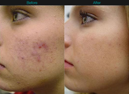 Dermaroller before and after acne photo